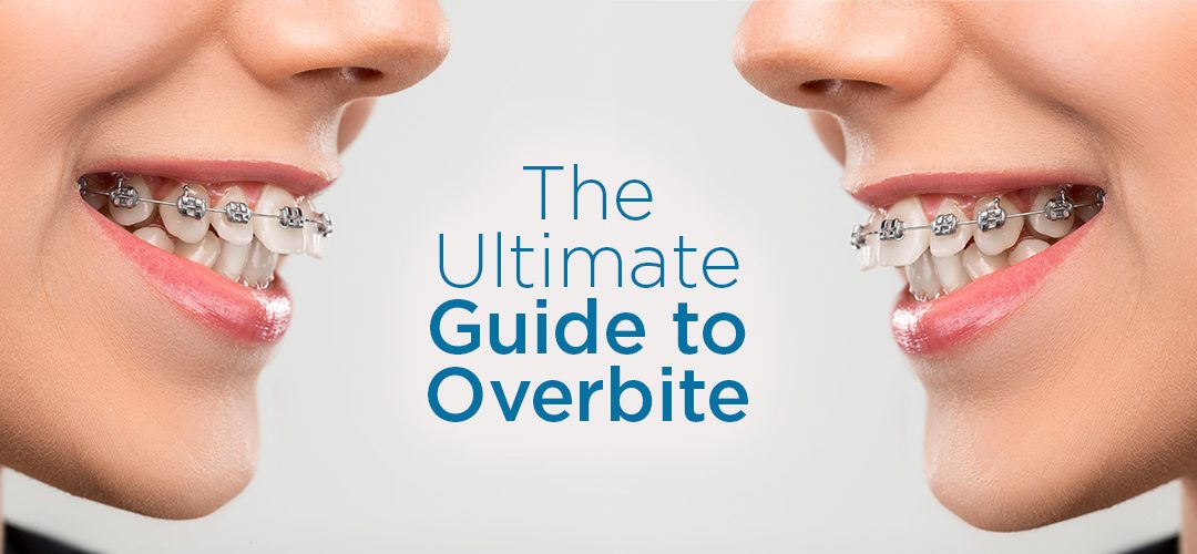 The Ultimate Guide to Overbite: What Is It, What Causes It, and What are the Treatment Options